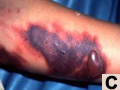 Patient with dengue hemorrhagic fever